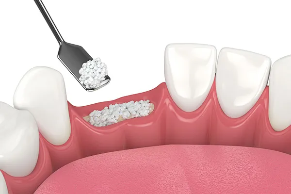 Bonegraft AdobeStock 469896869