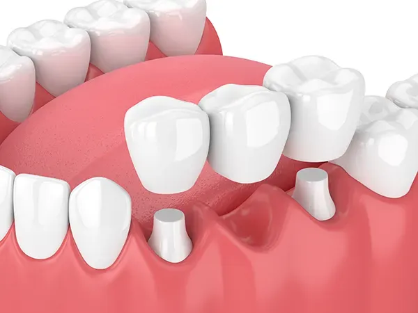 IMG dental bridge AdobeStock 198830090