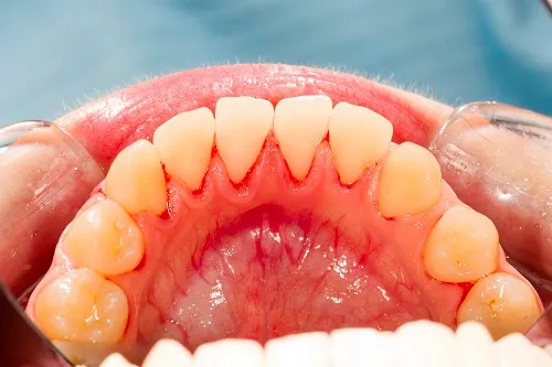 Teeth and irritated gums close up gum disease