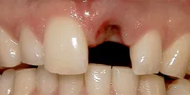 Implant surgery case 0 before