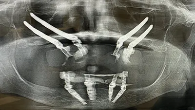 Implant surgery case 1 after 3