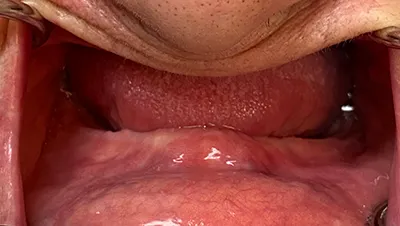 Implant surgery case 1 before 2