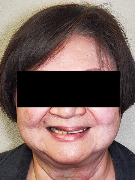 Implant surgery case 2 before 1