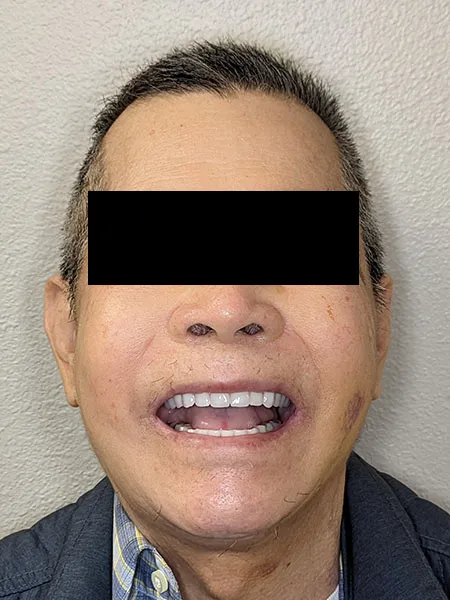 Implant surgery case 3 after 1