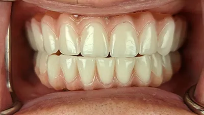 Implant surgery case 3 after 2