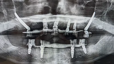 Implant surgery case 3 after 3