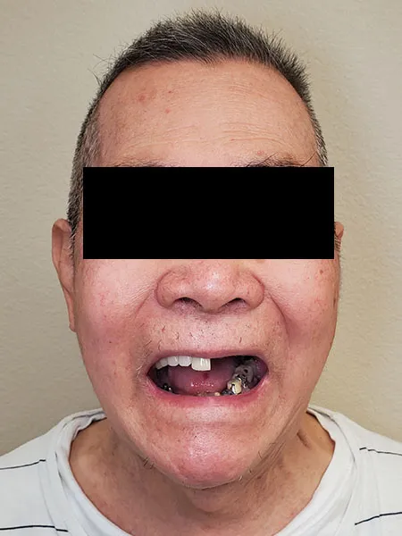 Implant surgery case 3 before 1