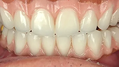 Implant surgery case 4 after 2