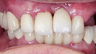 Implant surgery case 4 before 2