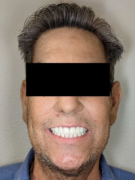 Implant surgery case 5 after 1