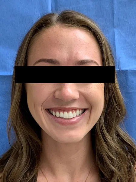 Jaw surgery case 1 after