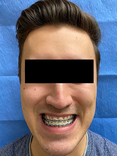Jaw surgery case 4 before
