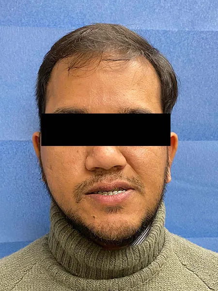 Jaw surgery case 5 before