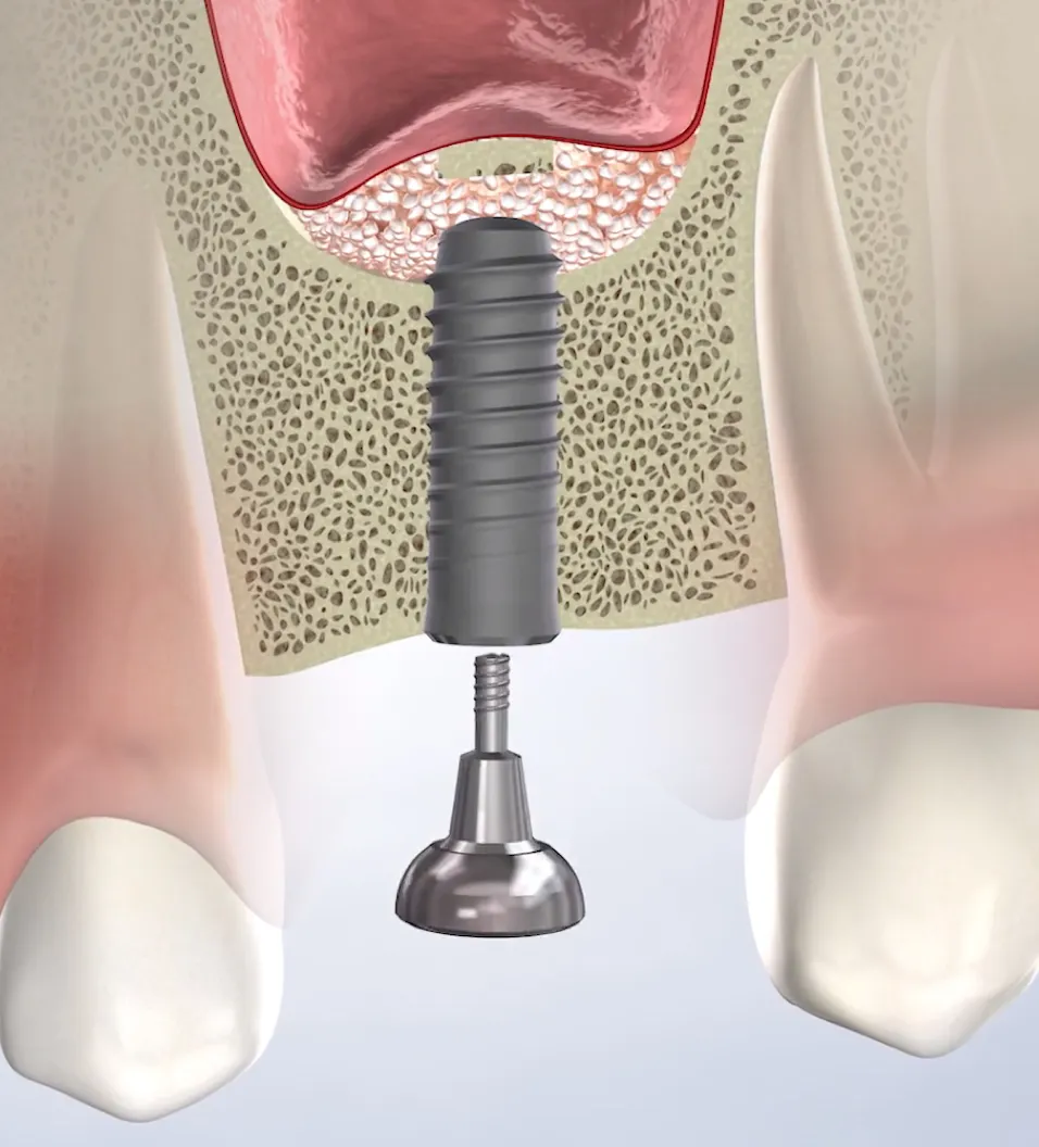 query  bone grafting